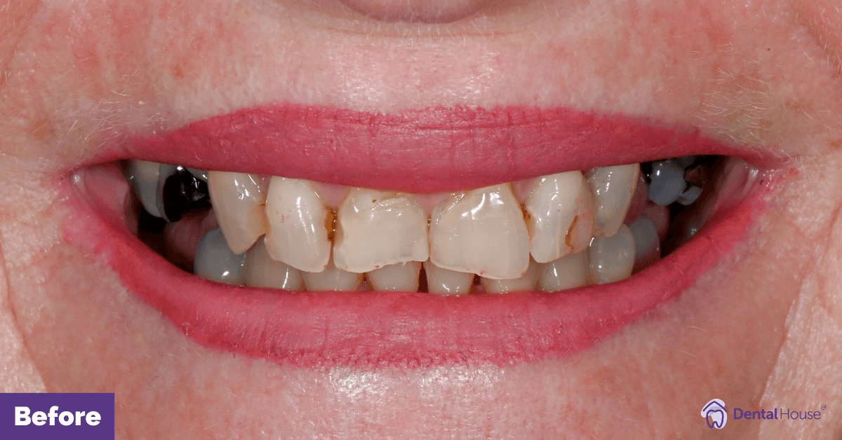 Porcelain-Veneers-Dental-Crown-in-DHG-3