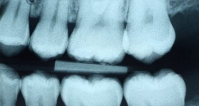Why Dental X-rays Are Needed?