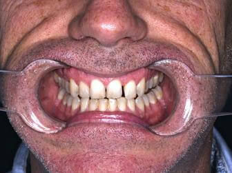 Crooked Teeth Bacchus Marsh, Melton & Ballan - Bacchus Marsh Dental House