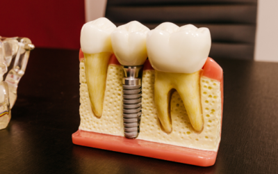How Dental Implants Prevent Jawbone Shrinkage After Tooth Loss
