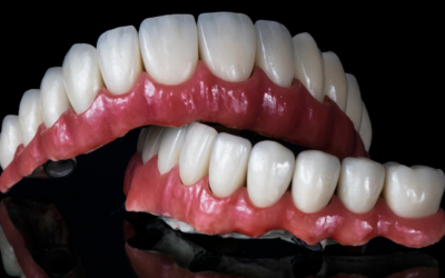 From Wobbly to Wonderful: All-on-4 Plus® for Severe Tooth Loss