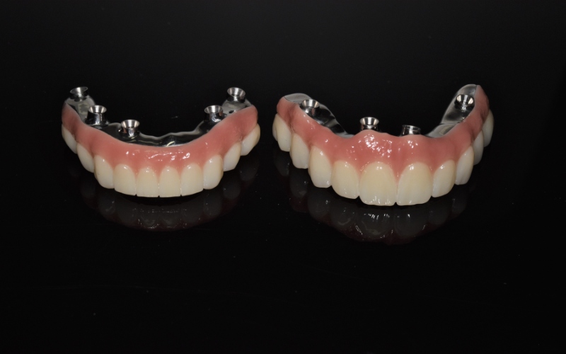 Second Chances Can All On 4 Plus Work After Battling Gum Disease in Bacchus Marsh Dental House
