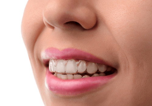 5 Reasons Why It’s Dangerous to Straighten Your Teeth Other than Invisalign 5 Reasons Why Its Dangerous to Straighten Your Teeth Other than Invisalign 500x350 1