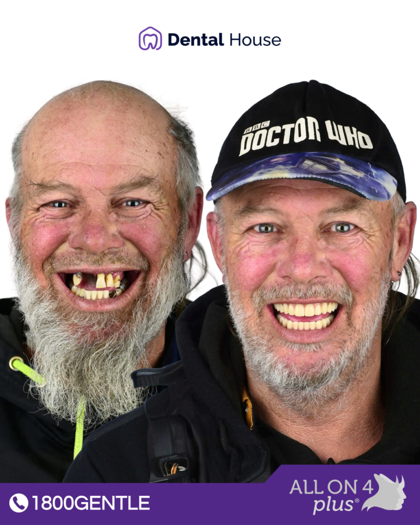 All On 4 Plus® Melton Dental House