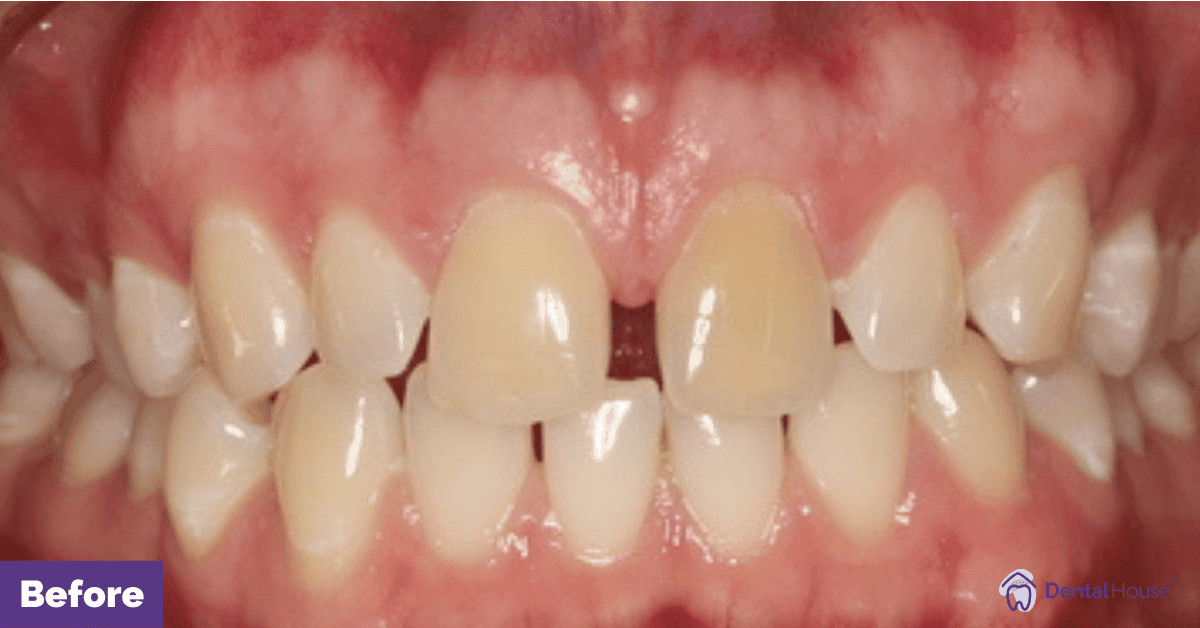 A’s Smile Makeover in Melbourne Gallery image