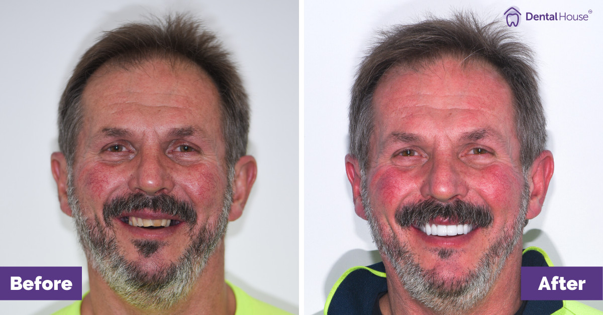 B’s Smile Makeover in Bacchus Marsh Gallery image