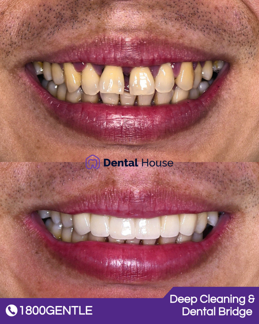 Deep Cleaning & Dental Bridge