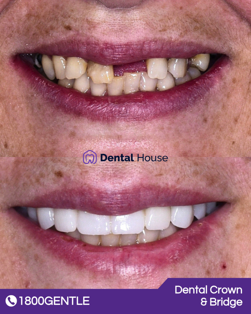 Dental Crown & Bridge