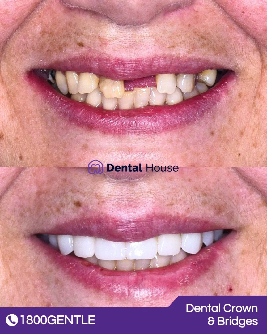 Treatment: Dental Crown & Bridges