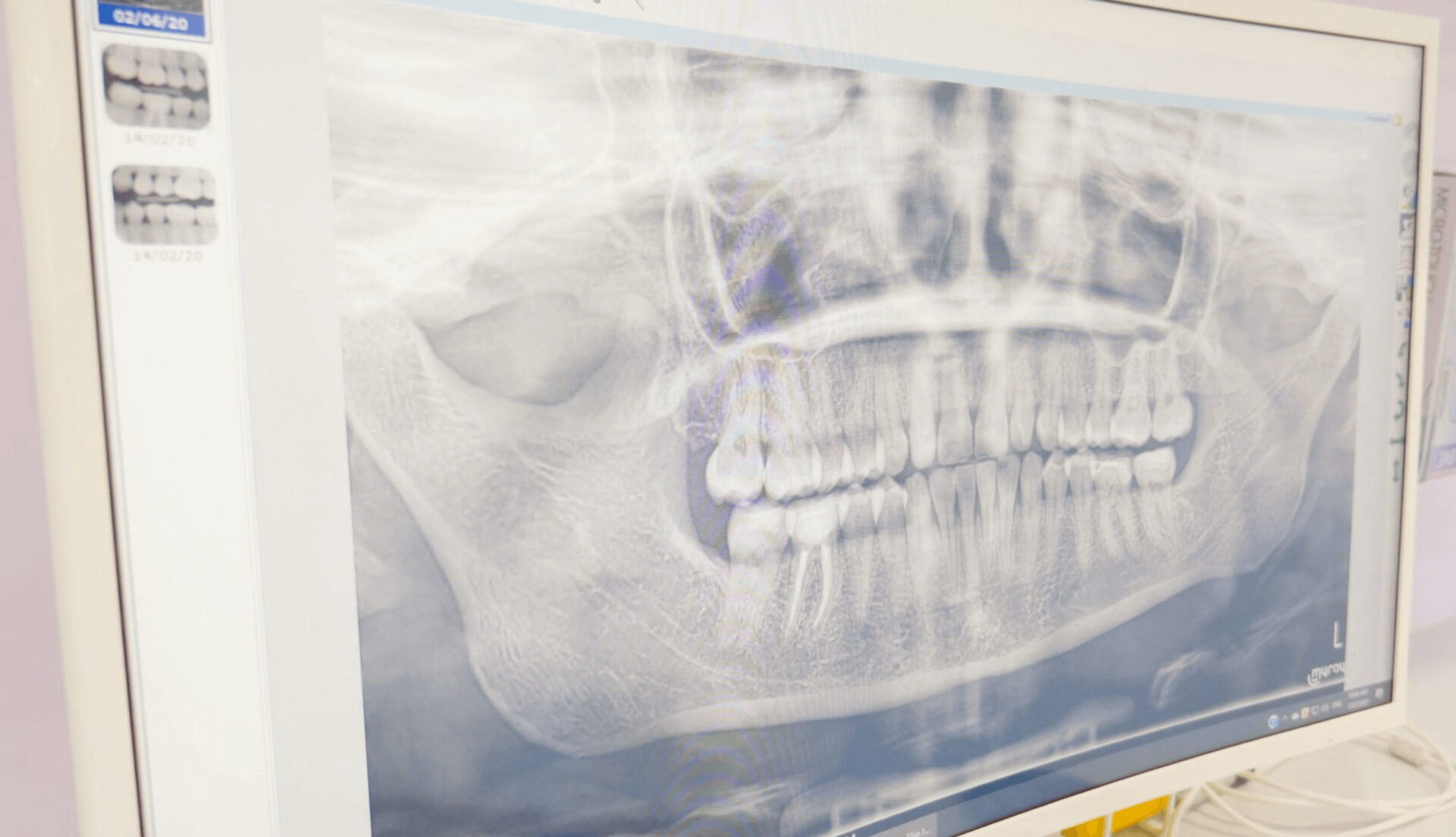 What Is The Cost Of Dental Implant? Dental House Group Dental Implant 1