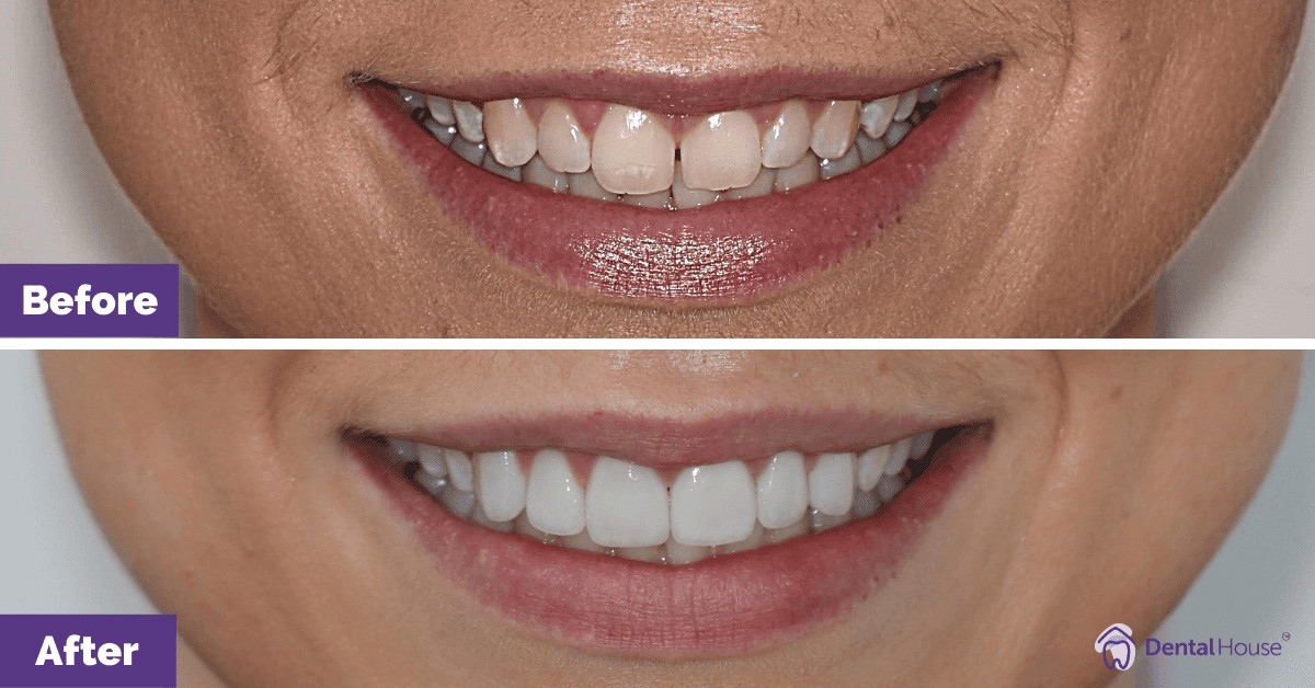 Stephanie’s Smile Makeover in Sunbury Gallery image