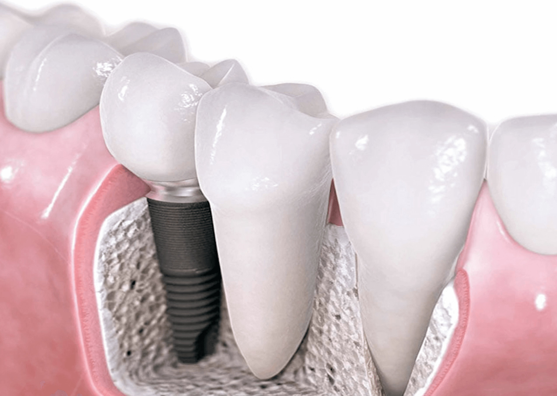 What Is The Cost Of Dental Implant? Dental Implant Dental House