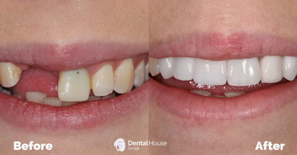 Implant & Crown Replacement Clinical Case in Bacchus Marsh Implant Crown Replacement Clinical Case in Bacchus Marsh 2