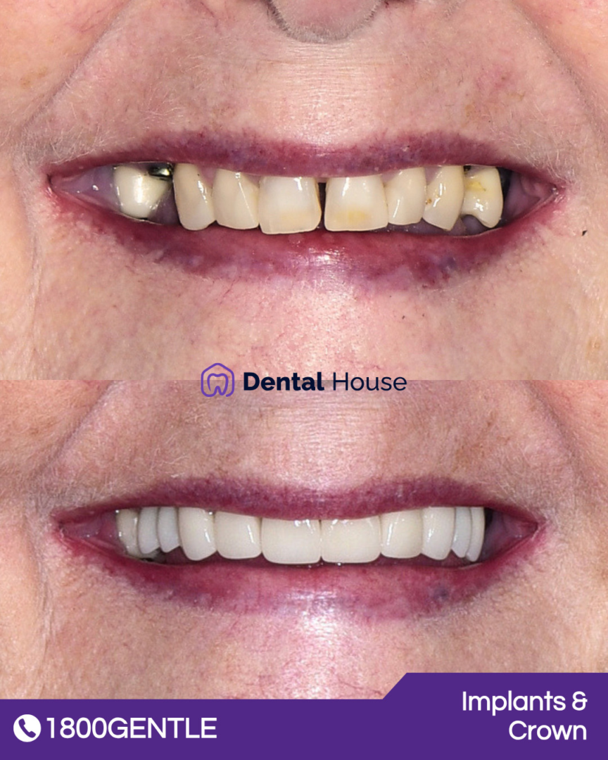 Implants & Crown
