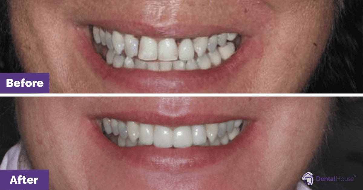 JL’s Porcelain Veneers & Crowns in Gisborne Gallery image
