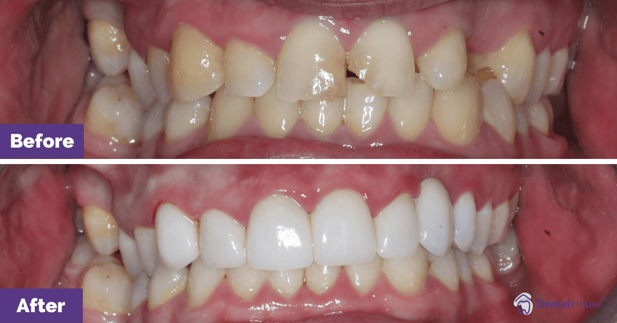 JY’s Zoom Whitening & Crown in Gisborne Gallery image