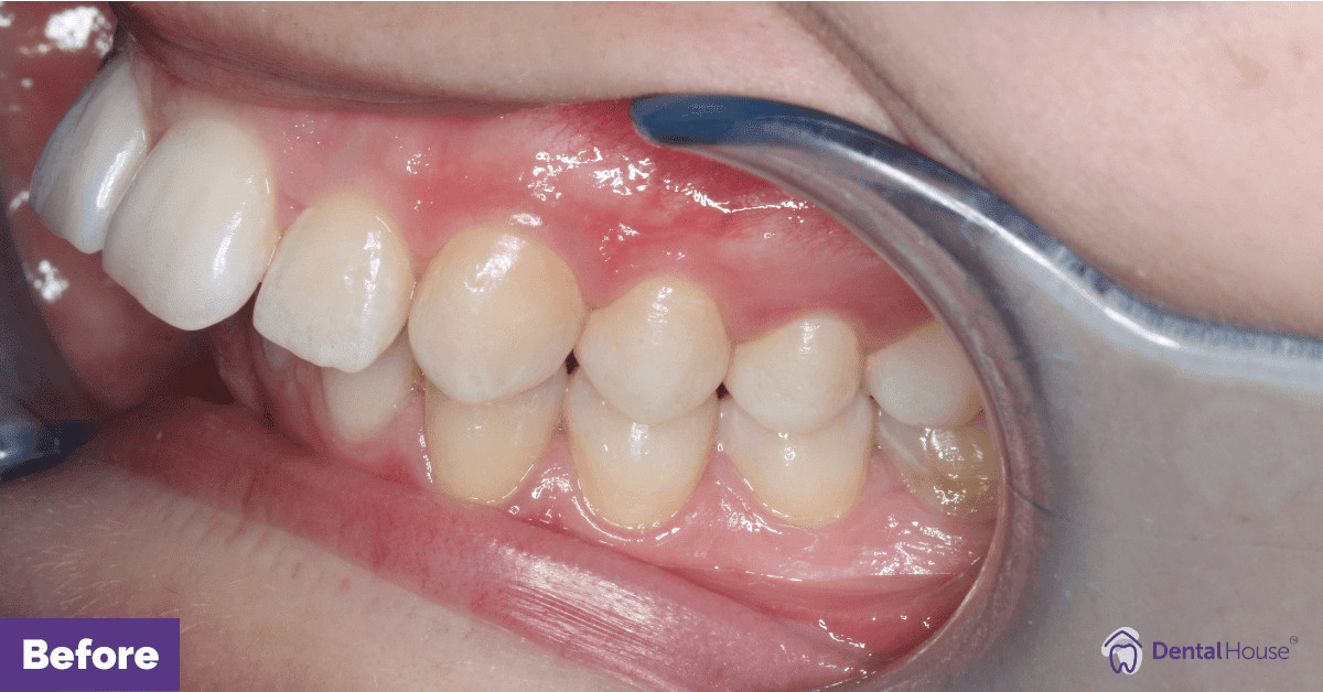 L’s Invisalign Smile Makeover in Bacchus Marsh Gallery image