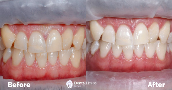 Professional Whitening Clinical Case in Bacchus Marsh Professional Whitening Clinical Case in Bacchus Marsh 1
