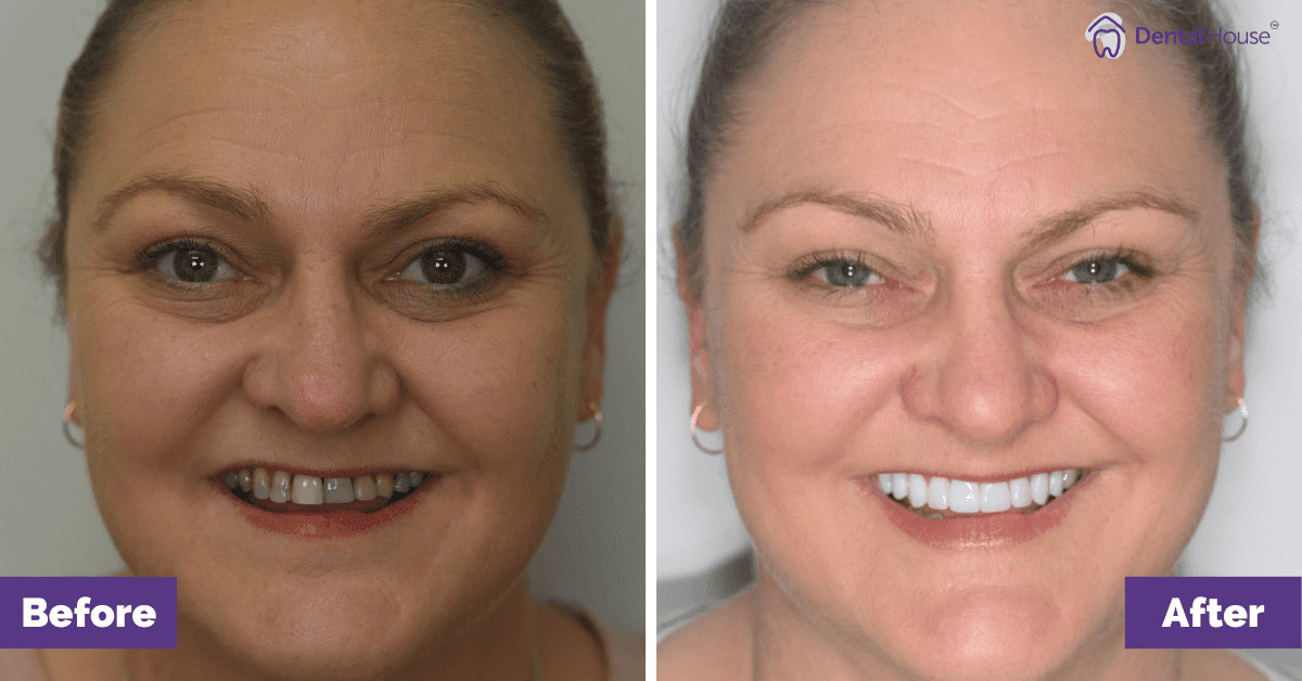Q’s Smile Makeover in Sunbury Gallery image
