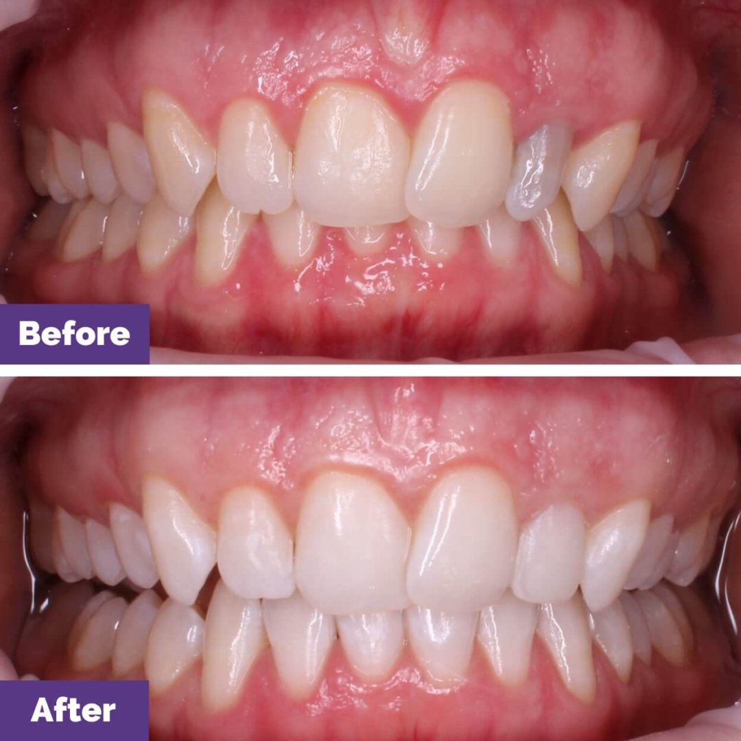 Teeth Whitening Journey at Sunbury