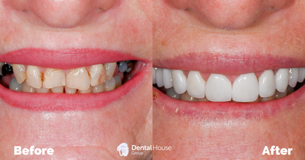 Veneers & Crowns Full Restoration Clinical Case in Bacchus Marsh Veneers Crowns Full Restoration Clinical Case in Bacchus Marsh 1