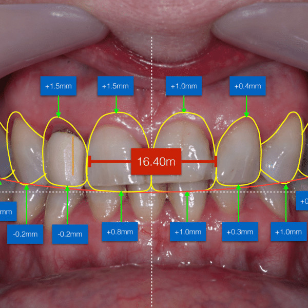 digital smile design at dental house group